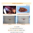 담낭용종수술후기. 우연히 건강검진으로 담낭에 용종이 있다는 사실을 알게 되었습니다. 이미지