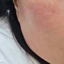 일므이 에스테틱 | 잠실피부관리 일므이에스테틱 얼굴 세범피지제거 후기