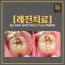 (주)익스플로에스 | 대구화원치과 충치치료 방치하면 어떻게 될까?