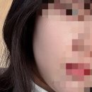 (주)아이피엘 | 피부과에 돈 많이 써 본 사람의 피부과 시술 및 관리 추천, 후기(리쥬란, LDM, 기미잡티 레이저 등)