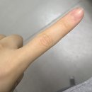 후의원 | 타투 제거_후기