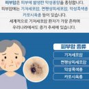 피부암 원인 예방 이미지