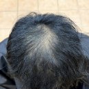 [2021-2026] 심한 남자 탈모, 5년째 '토탈탈모성형펌'에 열광하는 진짜 이유/ 부산사상주례감전덕포화명녹산 이미지