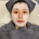 호인메디칼 | 청담피부과에서 받은 엑소라인 리파인 시술 효과 후기