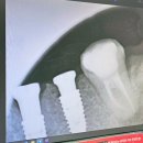 협진부분정비 | 강남역임플란트 vs 대학병원임플란트 가격비교 후 수술한 후기! 2개월 기록