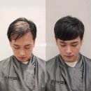 헤어증모술 가격 알아보고 자신감까지 얻은 후기