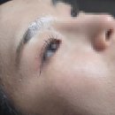1·3 달고식품 | 편평사마귀 제거 후기 편평사마귀 3대성지 1일차~한달후기
