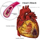 관상동맥 질환(Coronary Heart Disease) 이미지