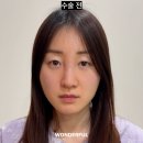 내 코를 찾아주세요 | 콧대필러 하고 다시 코수술한 후기