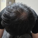 (주)메디플라머터리얼스 | 검정고양이의 내돈내산 탈모 관리 스토리 (남성형 탈모, 정수리 탈모)