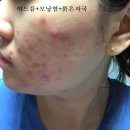 명현 | 피지억제제 이소티논 명현현상 부작용 극복 여드름 치료 후기
