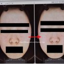 (주)바른나무파트너스 | 안산 중앙동 피부과 얼굴 기미 잡티제거 레이저 피코슈어토닝 10회 솔직후기 전후비교사진 (4/최종후기)