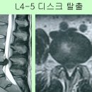 허리디스크의 중요한 예후, 좁은 척추관 사례 이미지