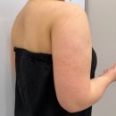 부여청담병원 | 여름 다이어트 팔뚝살빼기 이오팻주사 5회차 리얼후기!