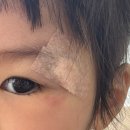 대전 영아 아기 열상 찢어짐 봉합 수술 양승돈 성형외과 솔직 후기