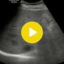 double channel sign(intrahepatic duct and portal vein are note) 이미지