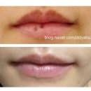 영등포데이뷰의원 | 클래리티 레이저로 입술점 빼기, 내돈내산 후기(비용,통증, 회복시간) @영등포 데이뷰의원