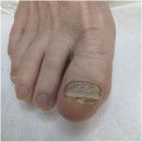 고잔236 | 안산 선부동 발톱무좀 할머니랑 꾸준히 찾는 오벨리네일푸스 족보있는그녀들 안산점