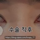 사선7길 5-6 | 눈밑지방재배치 눈밑지 수술 후기｜11~20일차 변화 붓기, 멍