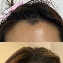 하드집 | [대전 용문동, 괴정동 왁싱] '애버그린뷰티' 1:1 맞춤 헤어라인 하드왁싱 후기