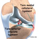 측부인대 손상(Collateral ligament injuries) 이미지