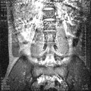 디스크 소견의 mri 이미지