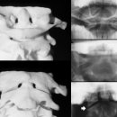 Cervical Spine Radiographs 이미지