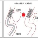 뇌동맥류 전조 증상 원인 코일색전술 (파열성, 비파열성 치료) 이미지