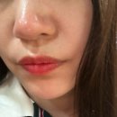 [뷰티] 서초피부과 코조각주사 2회차 후기 (내돈내산)