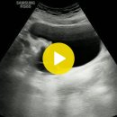 bladder diverticulum 이미지