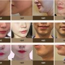 리프성형외과의원 네이버블로그
