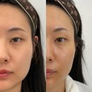 [율하동 피부관리] 살아있는 유산균으로 피부에 숨을! 아름다울유 유산균테라피 솔직 후기