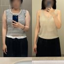 갠지 | 강남 팔뚝 지흡 2달 차 지방흡입 후기(+지방흡입 후 다이어트)
