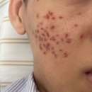 (주)점진 | 성남 분당 여드름 패인흉터 치료 후기 새살침 1회차