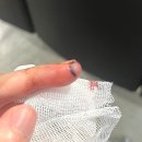 세란정형외과의원 | (약혐주의) 손가락 칼에 베이고 5바늘 꼬맨 썰 푼다...