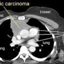흉선종, 흉선암 및 (가슴흉통 잦은기침 호흡곤란) 이미지