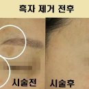 엄마손한의원 | 창원레이저토닝 후기 기미 제거 전후 비교