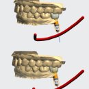 웰신경과의원 | 네비게이션 임플란트 후기- 천안 다나웰 치과 - 임플란트 잘하는 치과