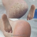 용산역 | [공지] 용산 발바닥 각질 제거 빛나러오소 용산역점 후기