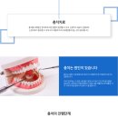 충치 치료 이미지