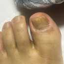 [녹번무좀발톱] 무좀발톱 케어 후기 &#39;디에고푸스-마이네일&#39;