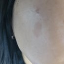 멍구미 | 구미 피부과 흑자제거 후기 비용 방법 부작용 주의사항