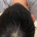 탈모약 4년째 , 프로페시아 말고 제네릭 피나온 피나원 헤어그로 다모케어 먹어도 괜찮을까?
