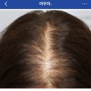 계양하루여성외과의원 | 신사역모발이식 후기｜여성 정수리·가르마 모발이식 1일차부터 2주차까지