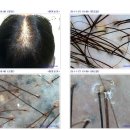 맘스터치 삼정점 | 부산두피관리 두피전문센터 모앤두피 부산경성대점 두피케어 후기