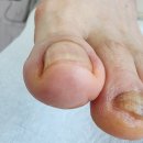 의왕 발톱무좀 무지외반 문제성발관리 꾸준한 1년 케어