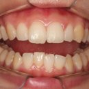 김태경치과의원 | 앞니 삐뚤빼뚤해요, 앞니부분교정으로 4개월만에 교정 종료 후기