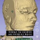 얼굴에 맞는 히알루론산 필러는 흡수되거나 녹아서 없어지지 않고 조직 확장을 유발합니다(다른 시술 추천 공유 하지말아주세요) 이미지