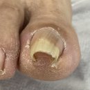부천내성발톱 교정 및 치료 중 관리 과정 후기
