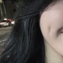 부산에서 보조개 수술 1년 4개월차 후기 ! 내돈내산